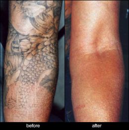 Best Tattoo Shops - Tattoo Removal and Cover-up